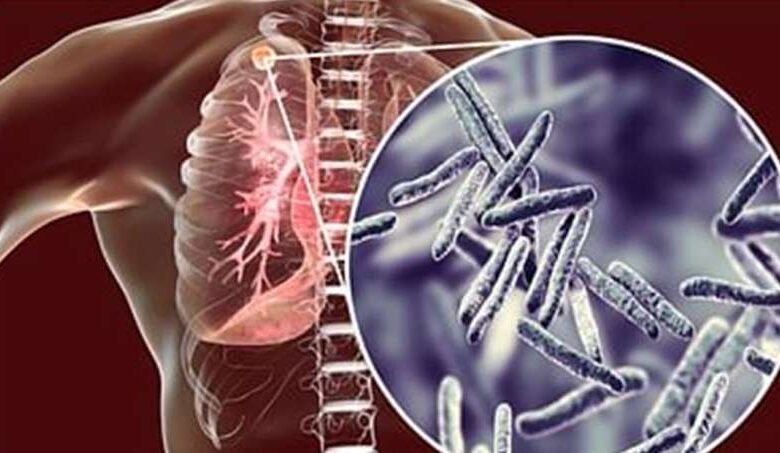 टीबी से मौत रोकने के लिए तमिलनाडु सरकार की नई रणनीति कारगर